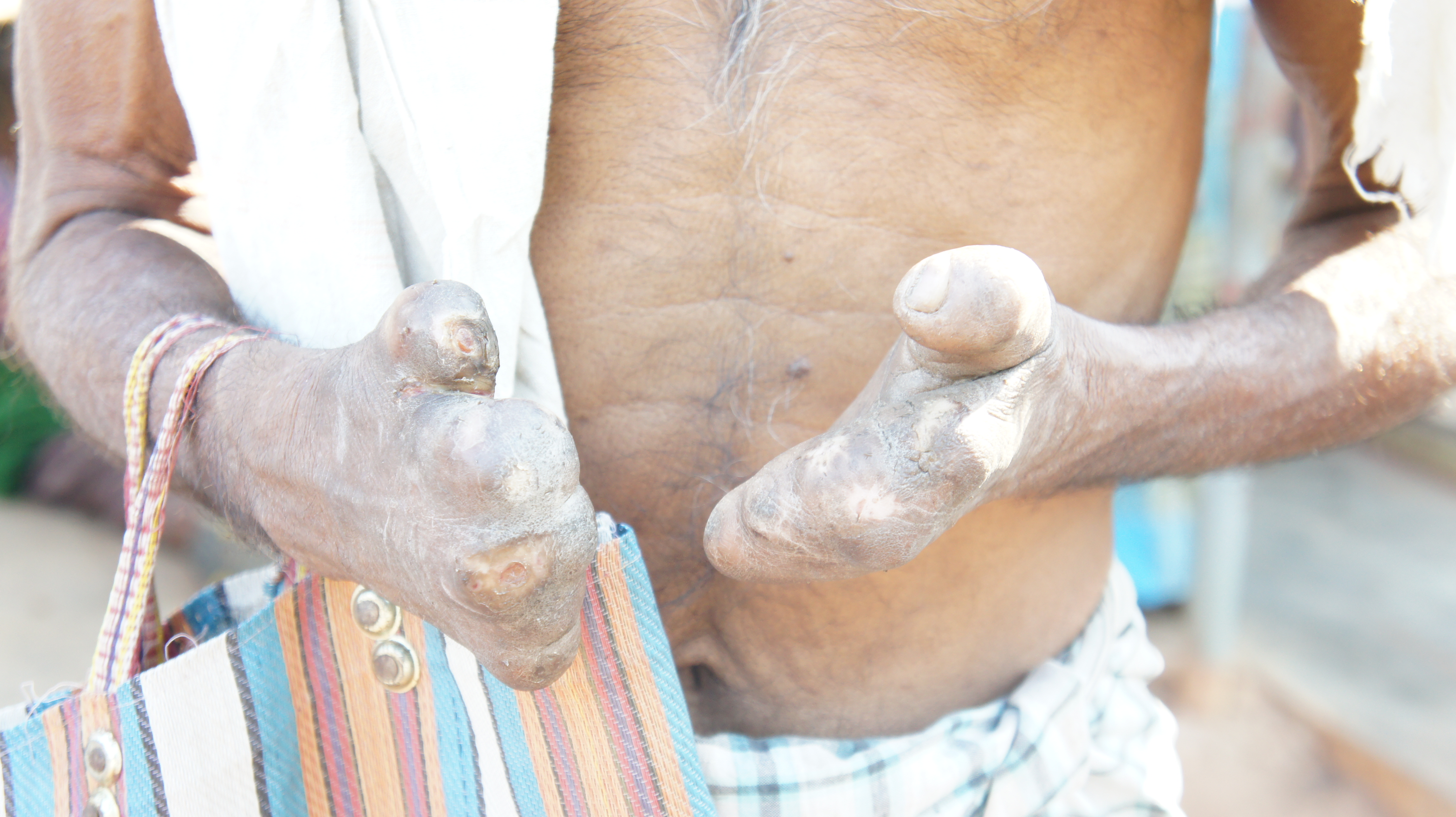 Leprosy Care image 10