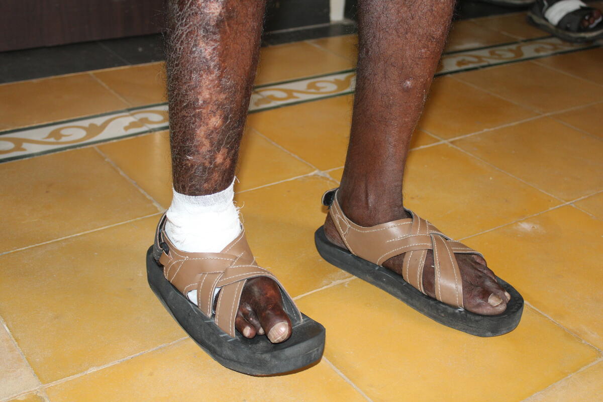 Leprosy Care image 20
